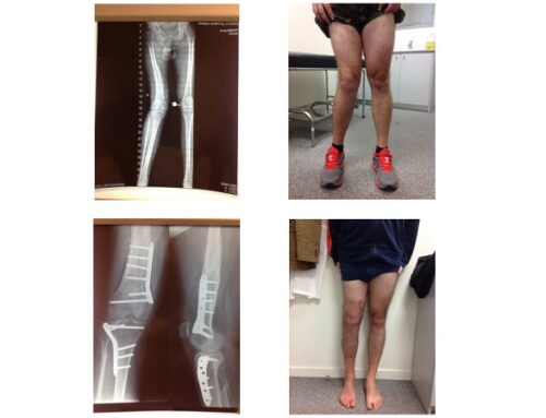 Αντιμετώπιση της αρθρίτιδας και των παραμορφώσεων του γόνατος με Οστεοτομίες.